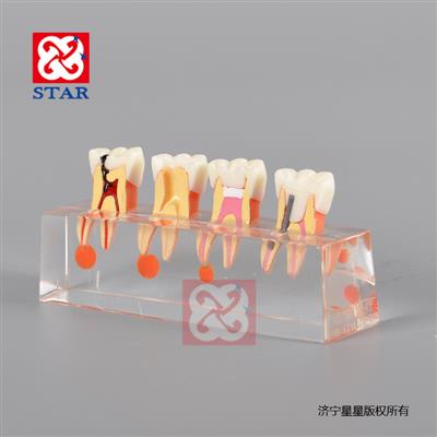 牙髓病治療模型M4018
